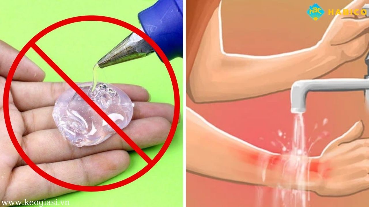 Cách xử lý khi bị bỏng do keo nến